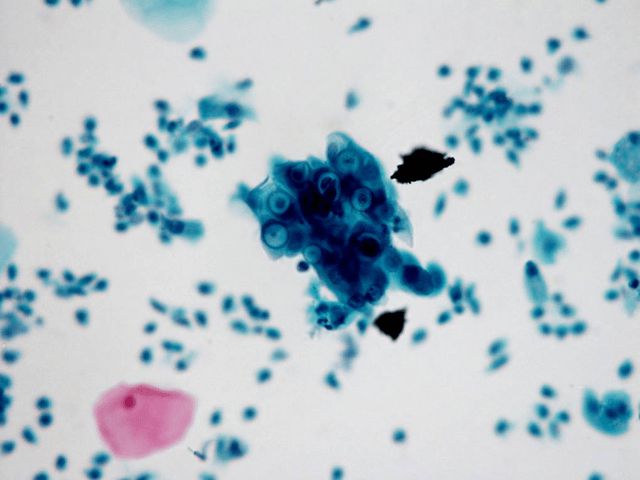 chlamydia trachomatis
